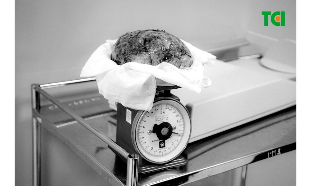 Khối u xơ tử cung “khủng” nặng đến 1.5kg (Ảnh TCI)