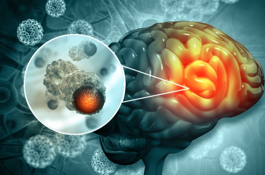 Nga tìm ra cách ngăn chặn sự phát triển của khối u não Nga tìm ra cách ngăn chặn sự phát triển của khối u não