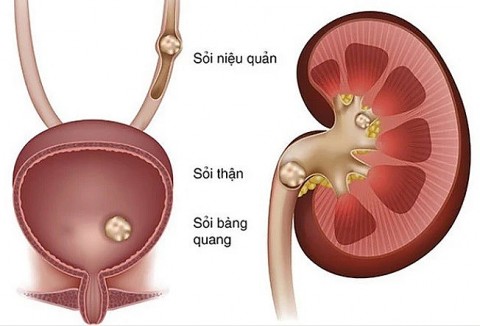 Cách ăn uống tốt nhất giúp ngăn ngừa hình thành sỏi thận