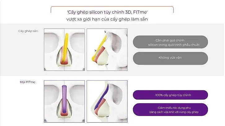 Công nghệ cấy ghép silicon tùy chỉnh mang tên “FITme 3D”
