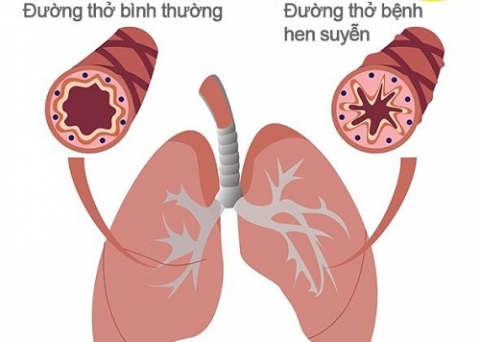 Người bệnh hen phế quản nên chú ý gì khi tập luyện?